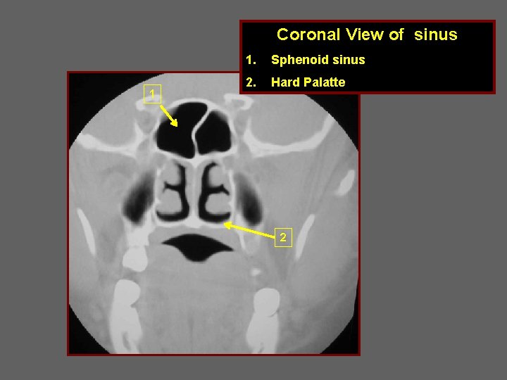 Coronal View of sinus 1 1. Sphenoid sinus 2. Hard Palatte 2 