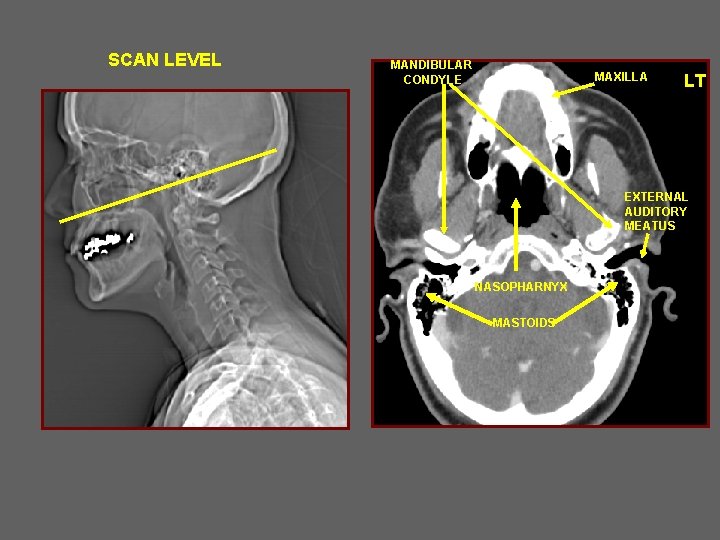 SCAN LEVEL MANDIBULAR CONDYLE MAXILLA LT EXTERNAL AUDITORY MEATUS NASOPHARNYX MASTOIDS 