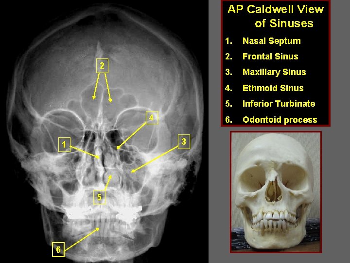 AP Caldwell View of Sinuses 2 4 3 1 5 6 1. Nasal Septum