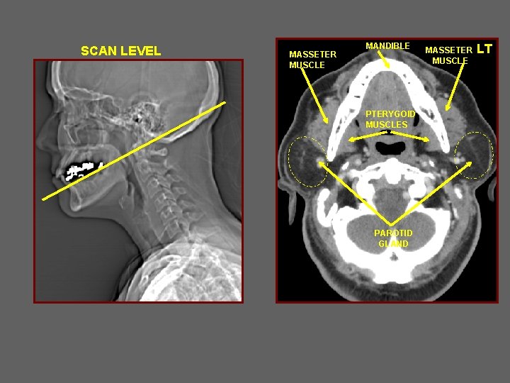 SCAN LEVEL MASSETER MUSCLE MANDIBLE PTERYGOID MUSCLES PAROTID GLAND MASSETER MUSCLE LT 