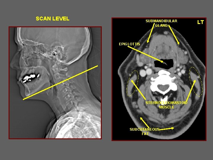 SCAN LEVEL SUBMANDIBULAR GLAND EPIGLOTTIS STERNOCLEIOMASTOID MUSCLE SUBCUTANEOUS FAT LT 