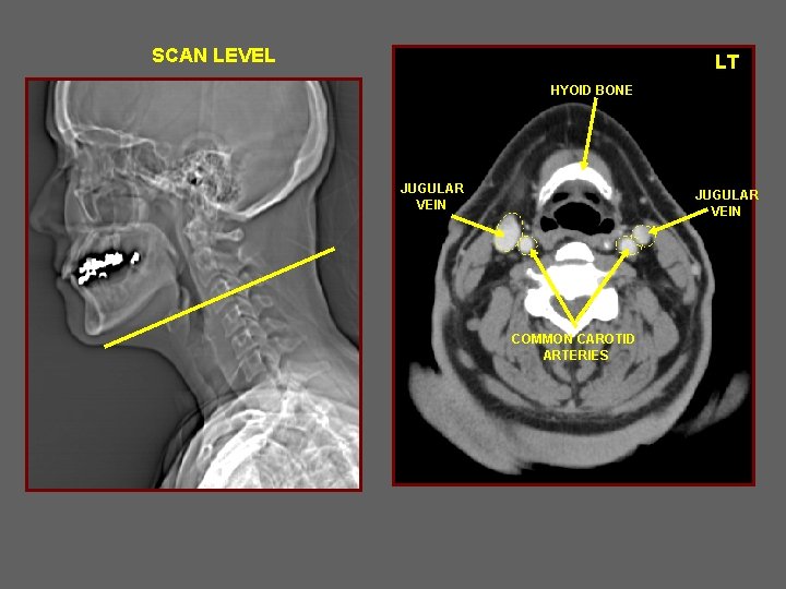 SCAN LEVEL LT HYOID BONE JUGULAR VEIN COMMON CAROTID ARTERIES 