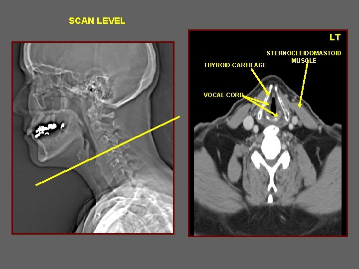 SCAN LEVEL LT STERNOCLEIDOMASTOID MUSCLE THYROID CARTILAGE VOCAL CORD 