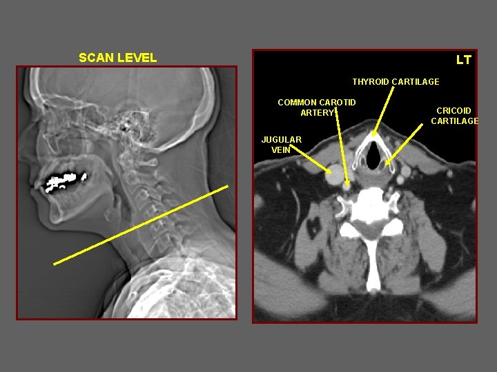 SCAN LEVEL LT THYROID CARTILAGE COMMON CAROTID ARTERY JUGULAR VEIN CRICOID CARTILAGE 