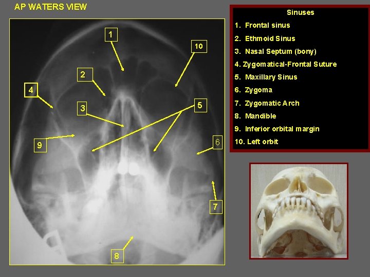 AP WATERS VIEW Sinuses 1. Frontal sinus 1 2. Ethmoid Sinus 10 3. Nasal