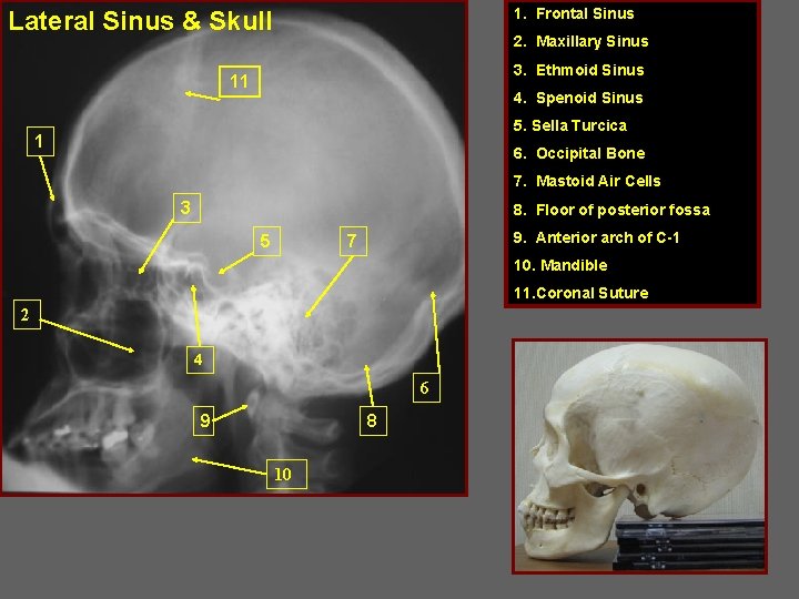 1. Frontal Sinus Lateral Sinus & Skull 2. Maxillary Sinus 3. Ethmoid Sinus 11