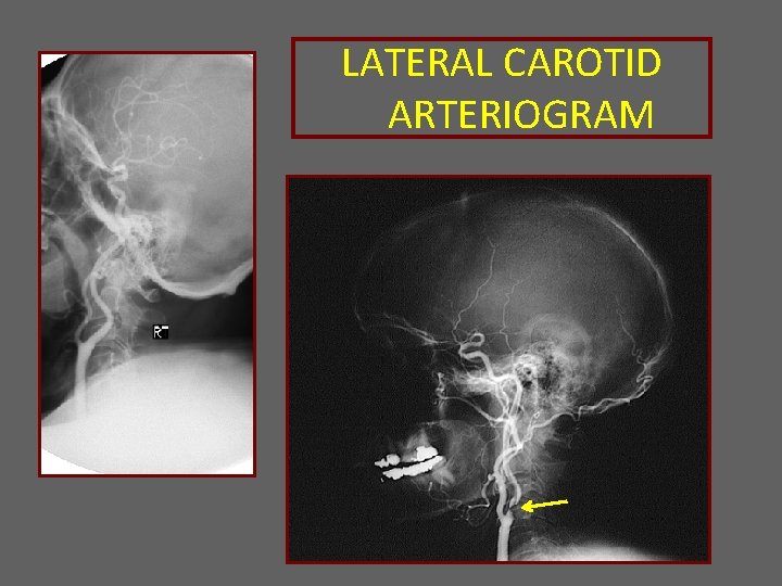 LATERAL CAROTID ARTERIOGRAM 