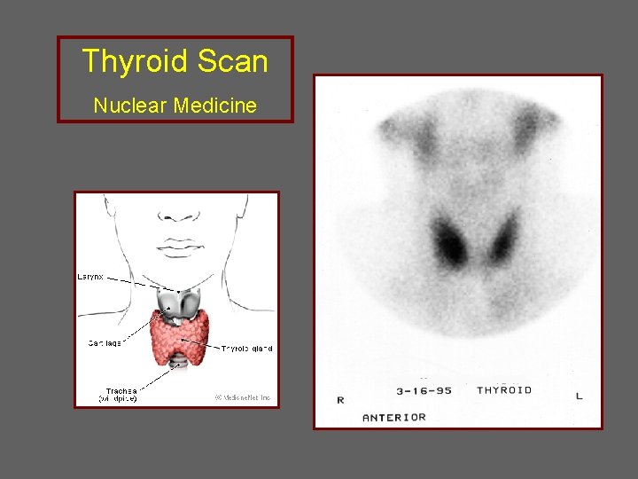 Thyroid Scan Nuclear Medicine 