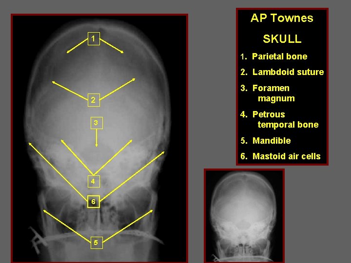 AP Townes SKULL 1 1 1. Parietal bone 2. Lambdoid suture 2 3 3.