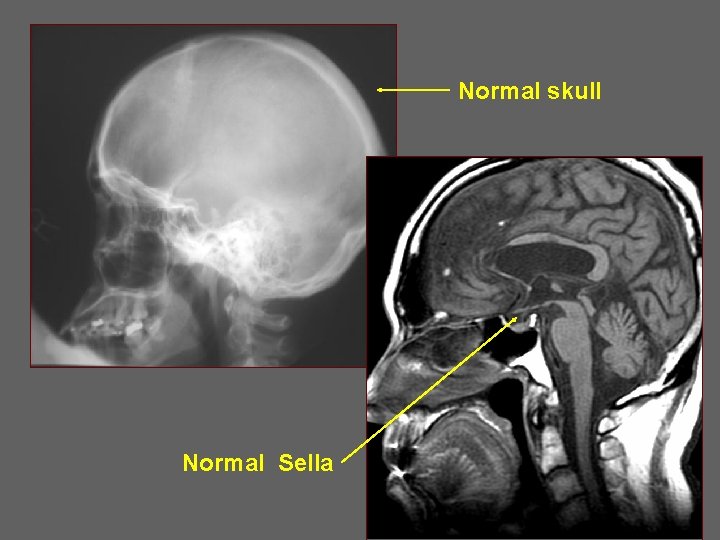 Normal skull Normal Sella 