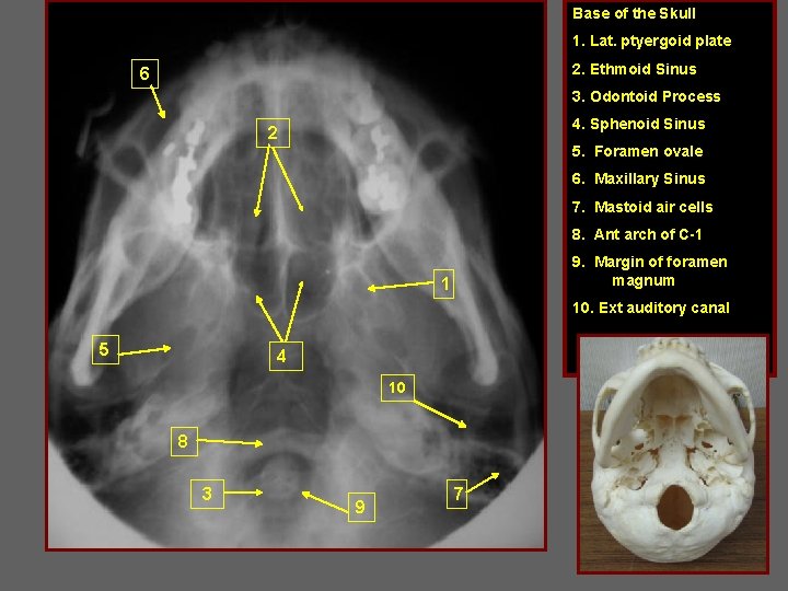 Base of the Skull 1. Lat. ptyergoid plate 2. Ethmoid Sinus 6 3. Odontoid