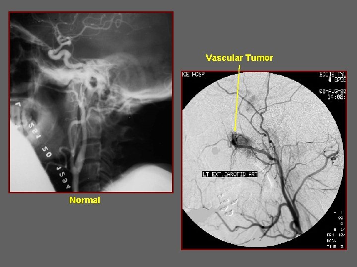 Vascular Tumor Normal 