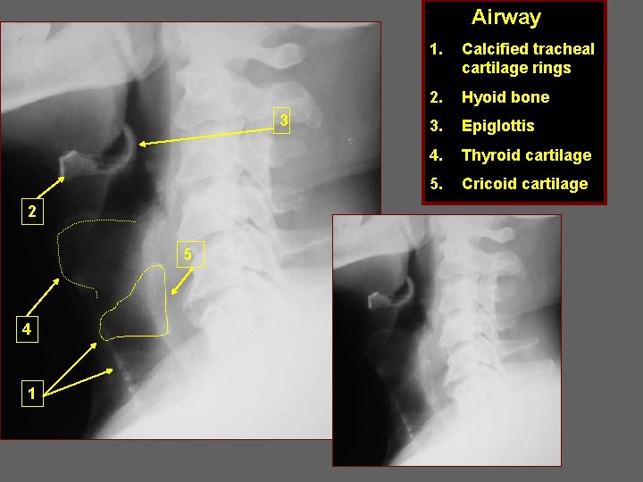 Airway 3 2 5 4 1 1. Calcified tracheal cartilage rings 2. Hyoid bone