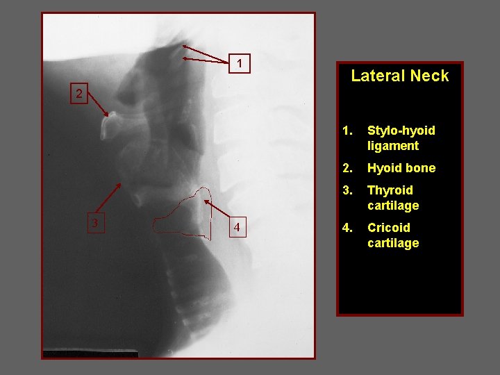 1 Lateral Neck 2 3 4 1. Stylo-hyoid ligament 2. Hyoid bone 3. Thyroid