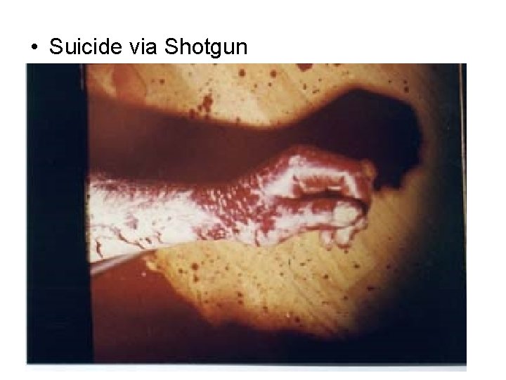  • Suicide via Shotgun 
