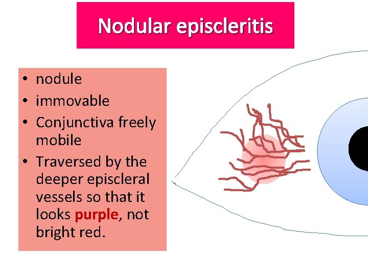 Nodular episcleritis • nodule • immovable • Conjunctiva freely mobile • Traversed by the