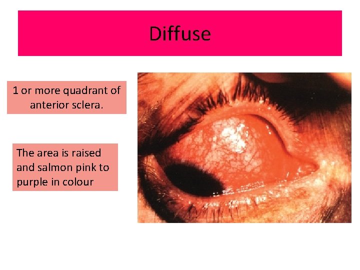 Diffuse 1 or more quadrant of anterior sclera. The area is raised and salmon