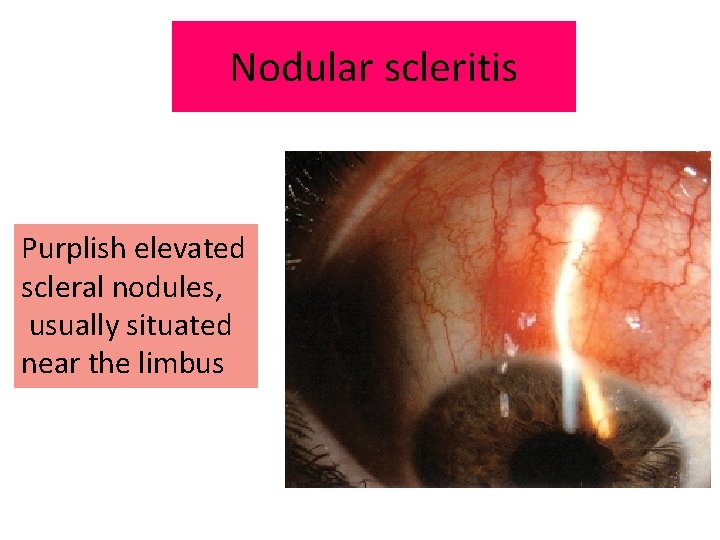 Nodular scleritis Purplish elevated scleral nodules, usually situated near the limbus 