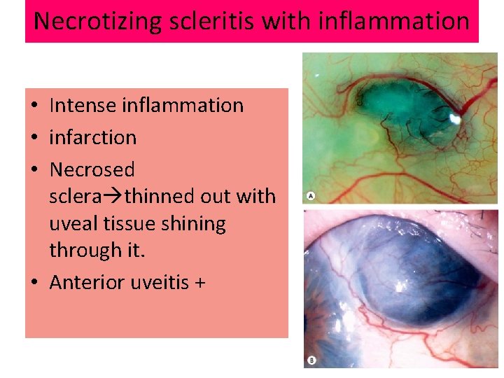 Necrotizing scleritis with inflammation • Intense inflammation • infarction • Necrosed sclera thinned out