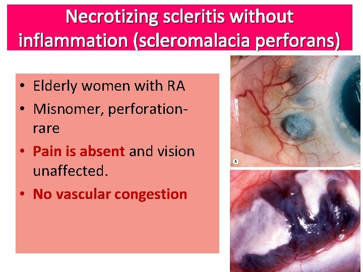 Necrotizing scleritis without inflammation (scleromalacia perforans) • Elderly women with RA • Misnomer, perforationrare