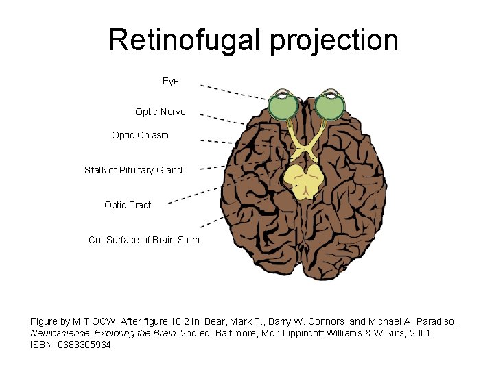 Retinofugal projection Eye Optic Nerve Optic Chiasm Stalk of Pituitary Gland Optic Tract Cut