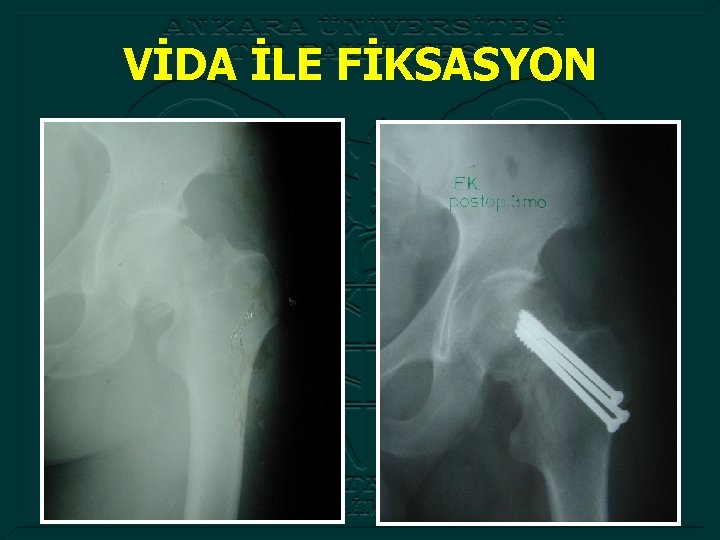 VİDA İLE FİKSASYON 