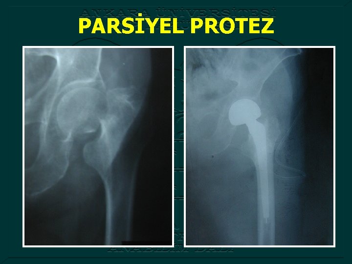 PARSİYEL PROTEZ 