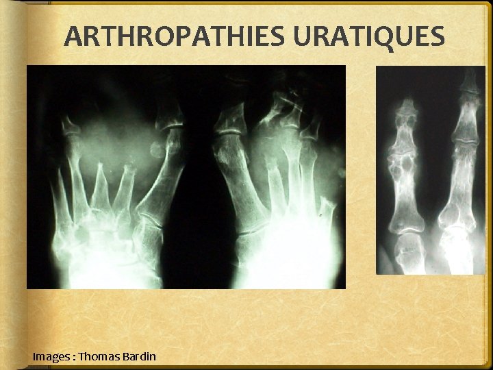 ARTHROPATHIES URATIQUES Images : Thomas Bardin 