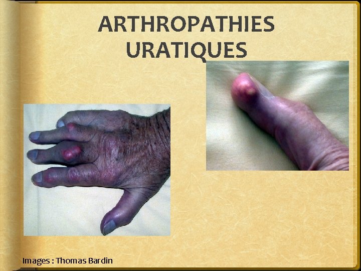 ARTHROPATHIES URATIQUES Images : Thomas Bardin 