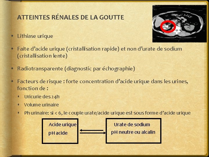 ATTEINTES RÉNALES DE LA GOUTTE Lithiase urique Faite d’acide urique (cristallisation rapide) et non