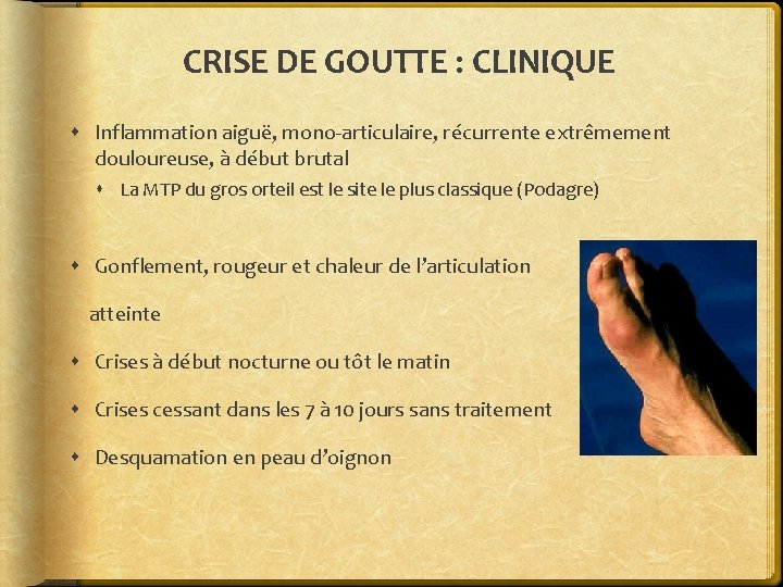 CRISE DE GOUTTE : CLINIQUE Inflammation aiguë, mono-articulaire, récurrente extrêmement douloureuse, à début brutal