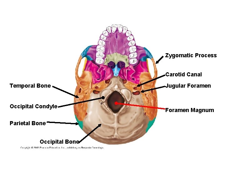 Zygomatic Process Carotid Canal Temporal Bone Occipital Condyle Parietal Bone Occipital Bone Jugular Foramen