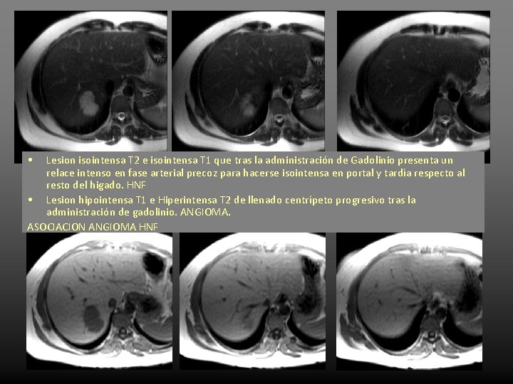  • Lesion isointensa T 2 e isointensa T 1 que tras la administración