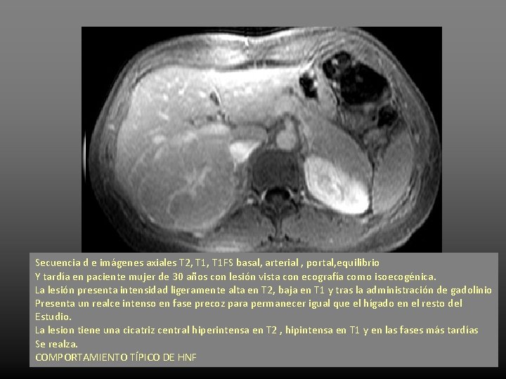 Secuencia d e imágenes axiales T 2, T 1 FS basal, arterial , portal,
