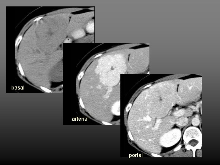 basal arterial portal 