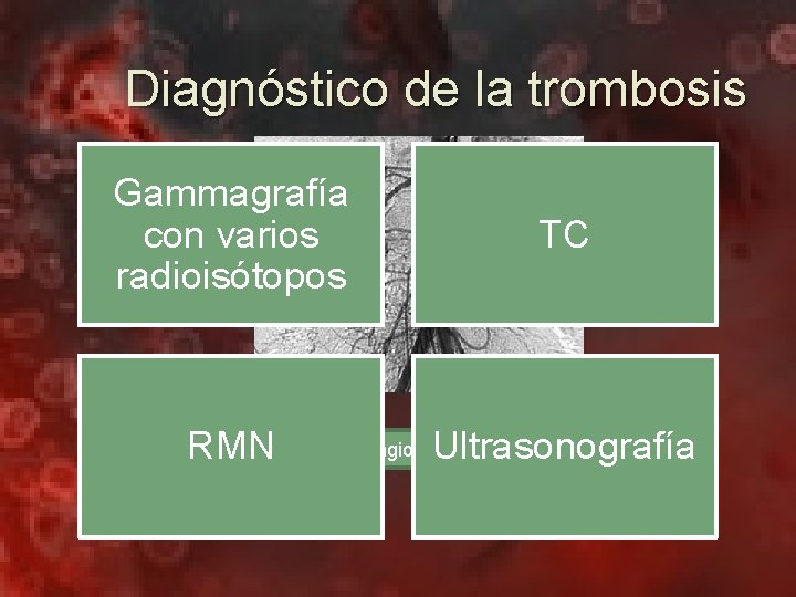 Diagnóstico de la trombosis Gammagrafía con varios radioisótopos RMN TC Ultrasonografía Angiografía 