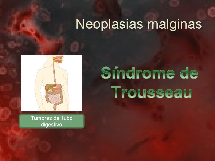 Neoplasias malginas Tumores del tubo digestivo 