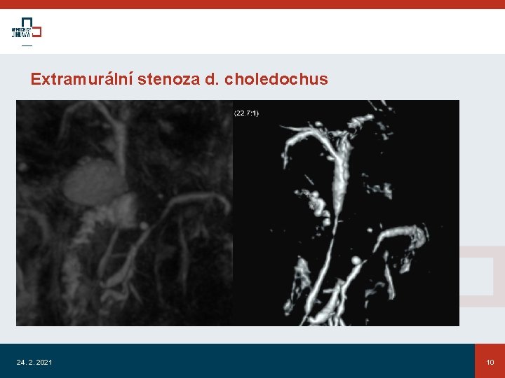 Extramurální stenoza d. choledochus 24. 2. 2021 10 