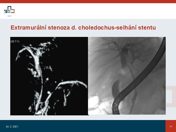 Extramurální stenoza d. choledochus-selhání stentu 24. 2. 2021 11 