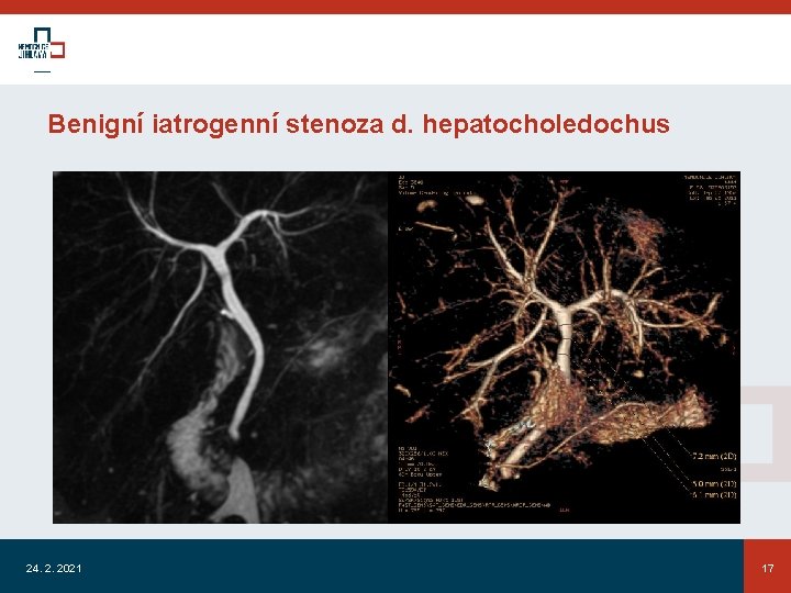 Benigní iatrogenní stenoza d. hepatocholedochus 24. 2. 2021 17 
