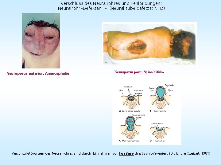 Verschluss des Neuralrohres und Fehlbildungen: Neuralrohr-Defekten - (Neural tube defects: NTD) Neuroporus anterior: Anencephalie