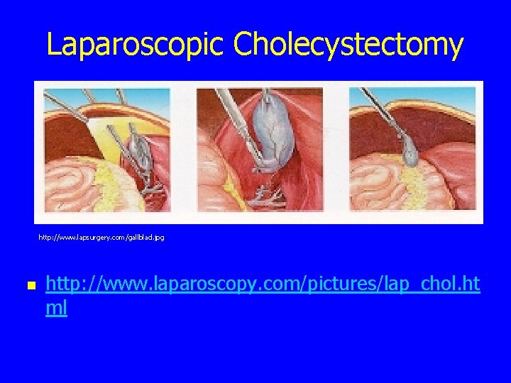 Laparoscopic Cholecystectomy http: //www. lapsurgery. com/gallblad. jpg n http: //www. laparoscopy. com/pictures/lap_chol. ht ml