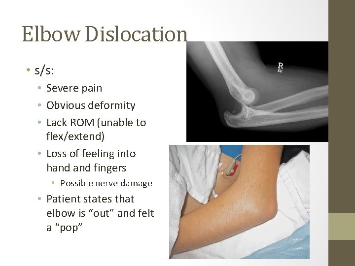 Elbow Dislocation • s/s: • Severe pain • Obvious deformity • Lack ROM (unable