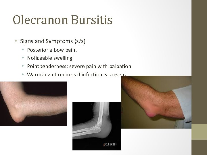 Olecranon Bursitis • Signs and Symptoms (s/s) • • Posterior elbow pain. Noticeable swelling