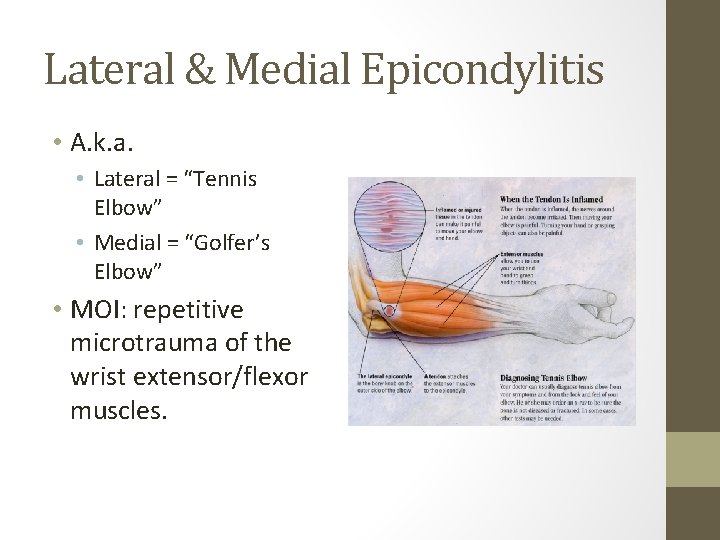 Lateral & Medial Epicondylitis • A. k. a. • Lateral = “Tennis Elbow” •
