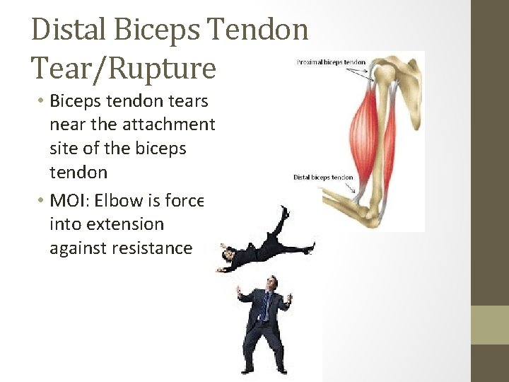 Distal Biceps Tendon Tear/Rupture • Biceps tendon tears near the attachment site of the