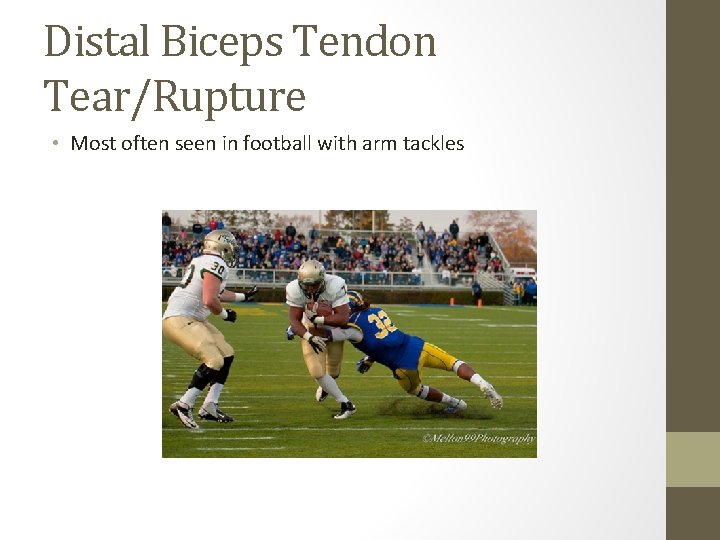 Distal Biceps Tendon Tear/Rupture • Most often seen in football with arm tackles 