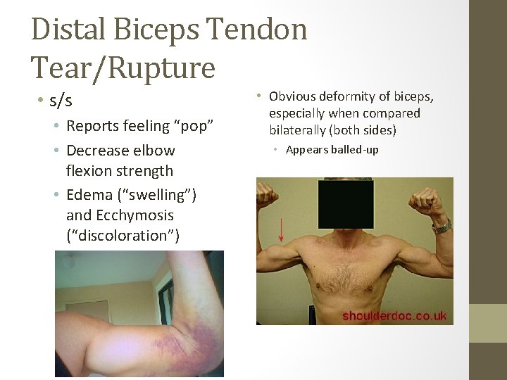 Distal Biceps Tendon Tear/Rupture • s/s • Reports feeling “pop” • Decrease elbow flexion