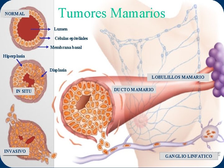 NORMAL Tumores Mamarios Lumen Células epiteliales Membrana basal Hiperplasia Displasia LOBULILLOS MAMARIO IN SITU