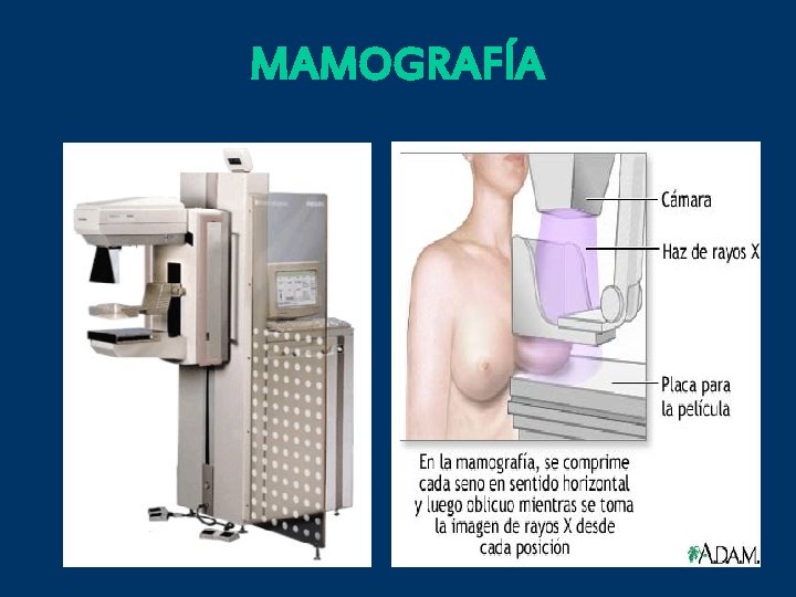 MAMOGRAFÍA 